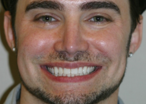 Case chad before query